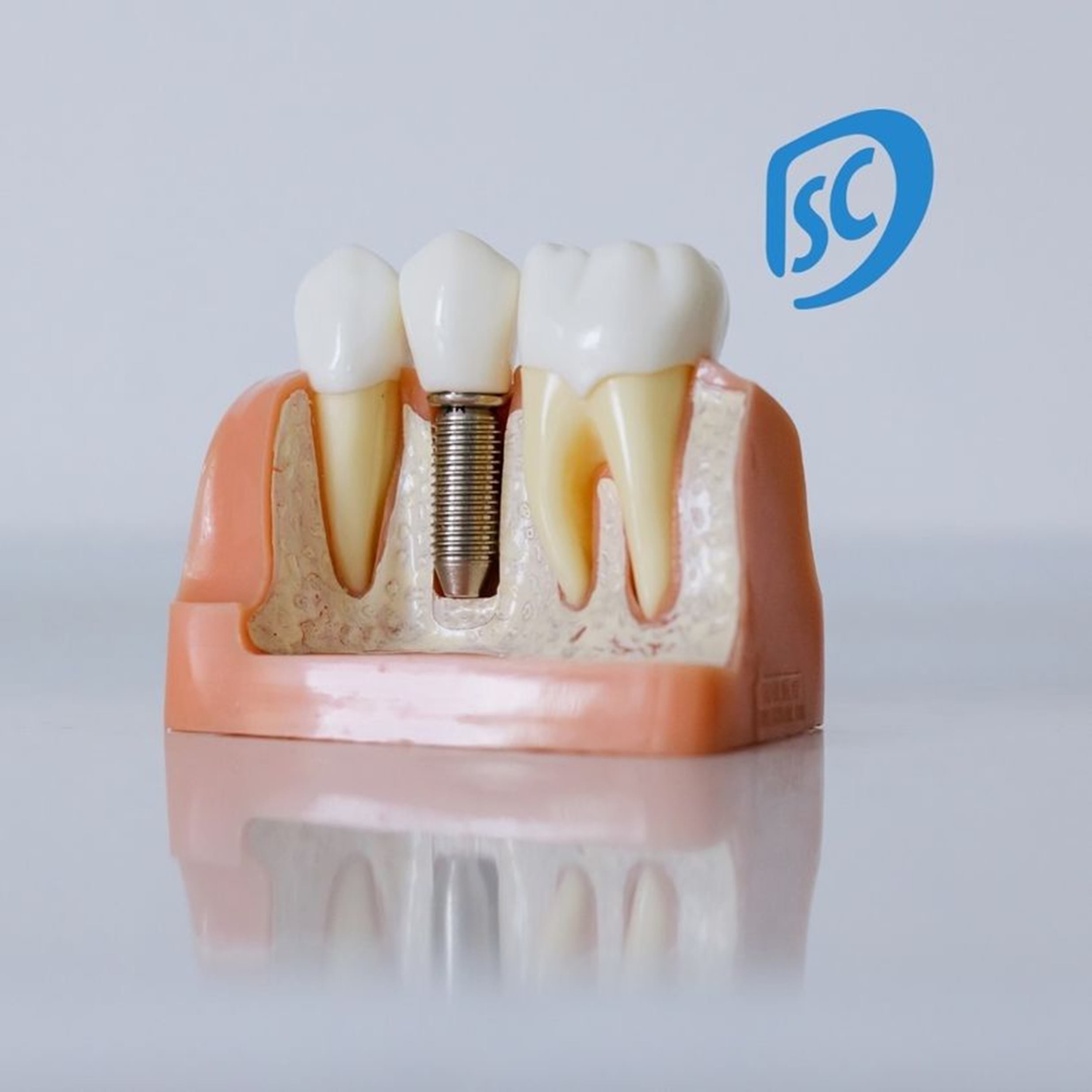 Implantes dentale